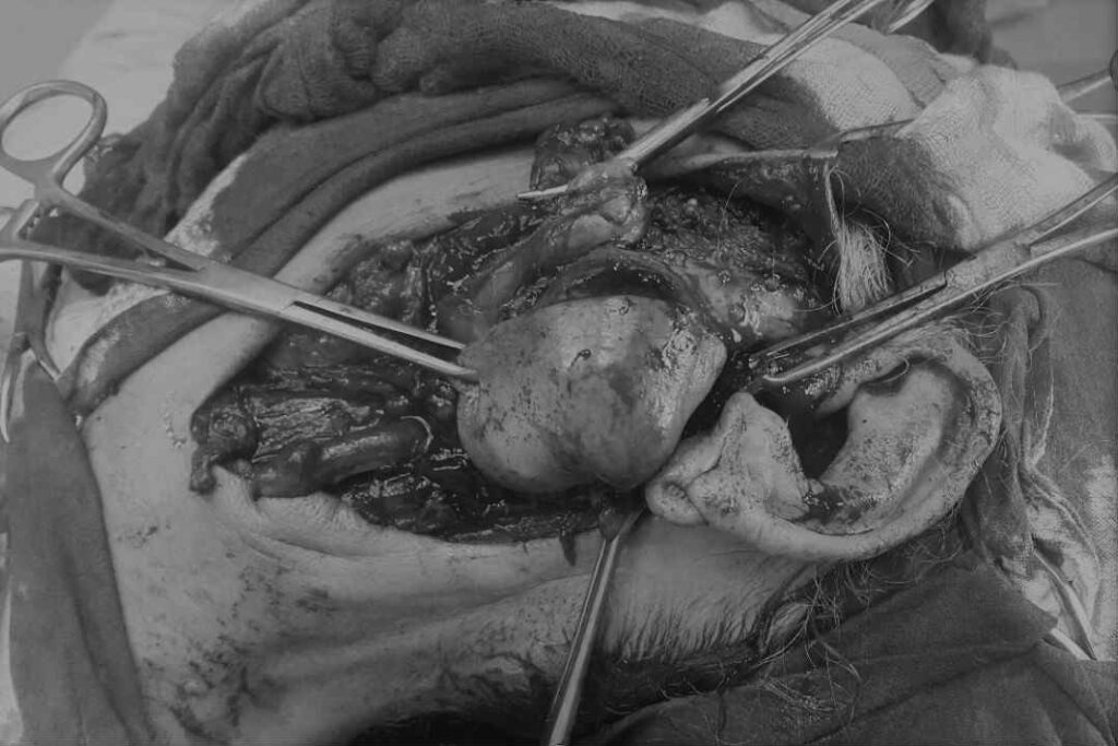 استئصال ورم بنجاح من الغدة النكافية