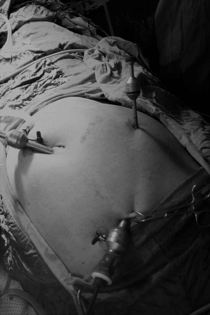 عملية استئصال المرارة بالمنظار من خلال ثلاثة فتحات فقط