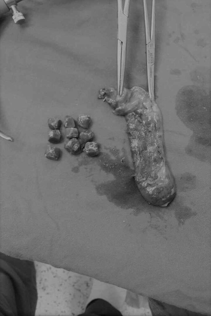 عملية استئصال مرارة بالمنظار بسبب وجود حصوات