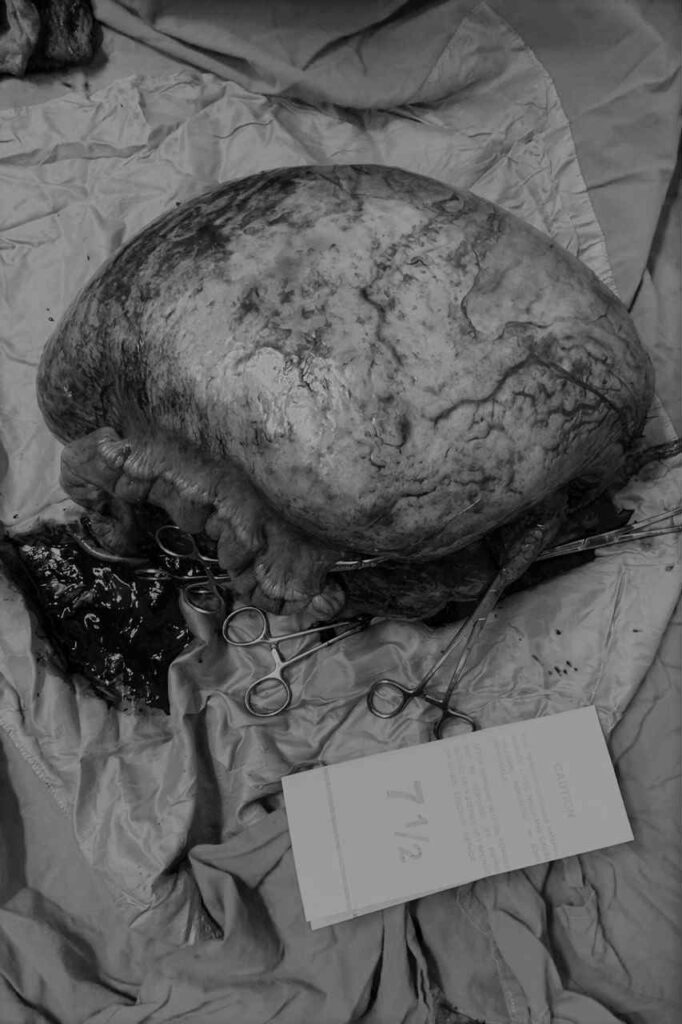 عملية استئصال ناجحة لورم كبير في البطن