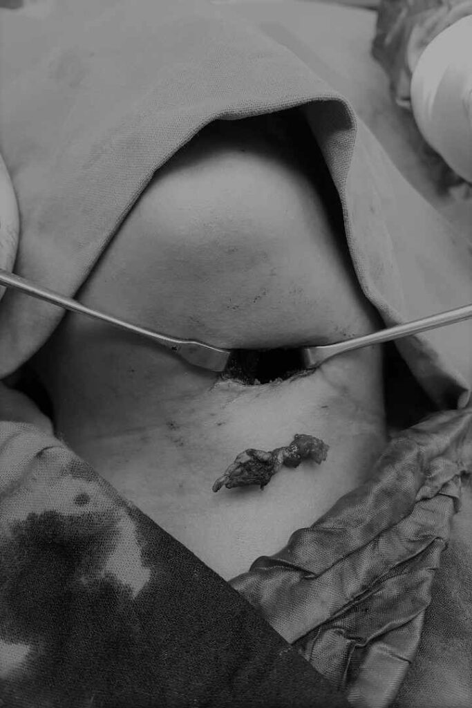 عملية استئصال ناسور درقي