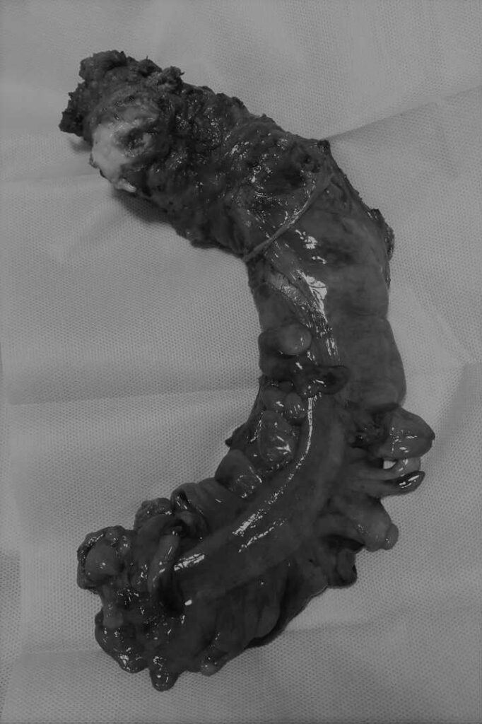 عملية استئصال ورم بالقولون