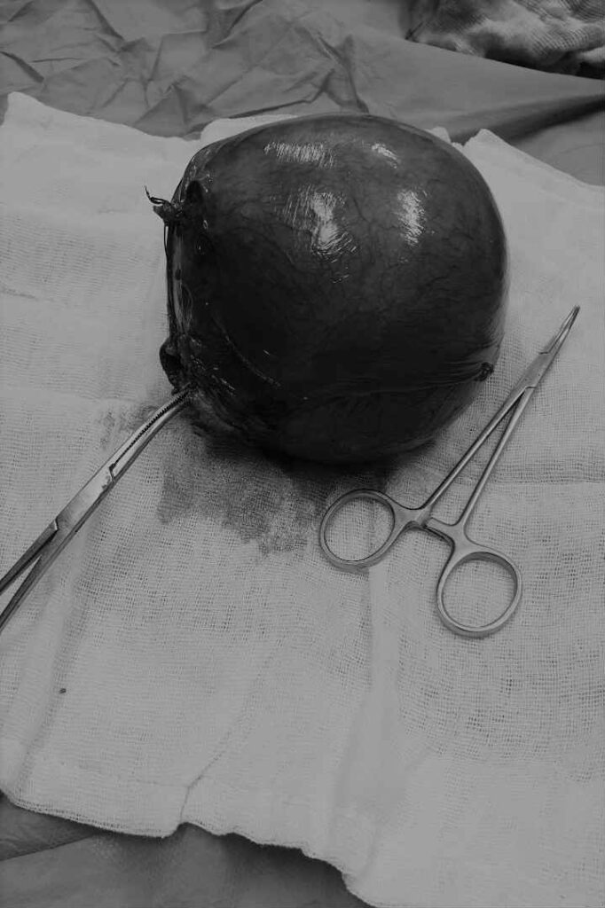 عملية استئصال ورم ضخم من الرحم