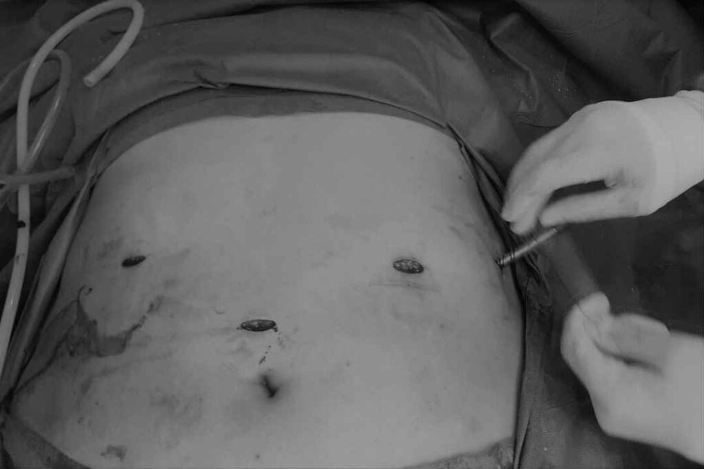 عملية تكميم للمعدة بالمنظار