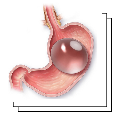 المعدة بالمنظار