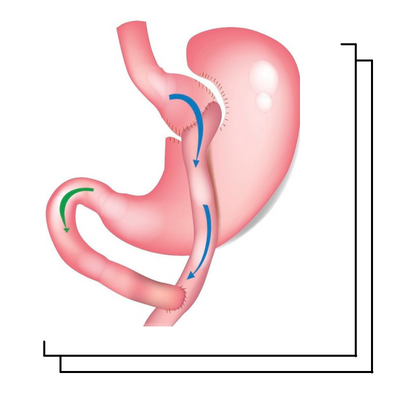 مسار المعدة بالمنظار