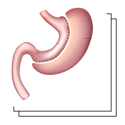 المعدة بالمنظار